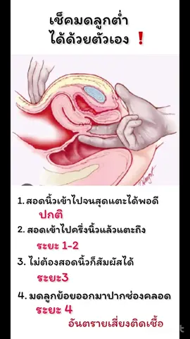 เช็คมดลูกต่ำ ได้ด้วยตัวเอง❗️💢 #ฤดีวัฒนาคลินิกสุรินทร์ #สุรินทร์ #ฤดีวัฒนาคลินิกการแพทย์แผนไทยชัยนาท #หมอป๊อปชัยนาท #หมอป๊อปสุรินทร์ #fy #fypシ #ฟีดดดシ #ดันขึ้นฟีดที #มดลูกหย่อน #มดลูกต่ํามดลูกหย่อน #ปวดท้อง #ปวดหน่วงท้อง 