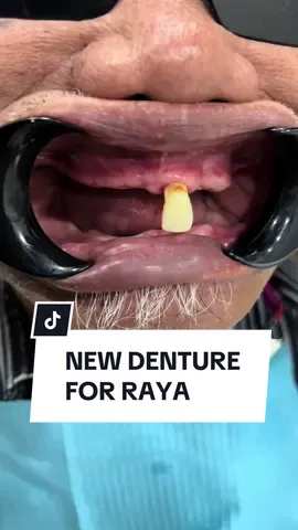 New denture just in time for Raya for this cute pakcik 😍  #fyp #fypシ #raya2024 #dentures #gigipalsu #dentist #dentistkl #dentistmalaysia🇲🇾 