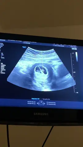 Primera ecografía con 6 semanas y media 💘✨… l@s esperamos con ansias!!!! 🙏🏻 #fyp #embarazo #pregnant #gemelos #embarazada #ecografia 