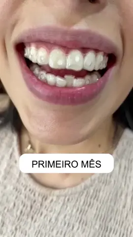 Vídeo demonstrando como funciona o tratamento com os alinhadores. O tratamento com alinhadores invisíveis utiliza uma série de alinhadores transparentes personalizados para gradualmente mover os dentes para a posição desejada. Esses alinhadores são substituídos a cada algumas semanas à medida que os dentes se ajustam. É uma opção discreta e conveniente para correção ortodôntica. As vantagens dos alinhadores invisíveis em relação aos aparelhos fixos incluem: 1. Discrição: Os alinhadores são praticamente invisíveis, tornando-os uma opção estética popular. 2. Removibilidade: Eles podem ser removidos para comer, escovar e passar fio dental, facilitando a higiene oral. 3. Conforto: Alinhadores são feitos de material suave e flexível, o que tende a ser mais confortável do que os fios e bráquetes dos aparelhos fixos. 4. Menor impacto na dieta: Como podem ser removidos durante as refeições, não há restrições alimentares tão rigorosas quanto com os aparelhos fixos. 5. Menos consultas ao dentista: Geralmente, requerem menos visitas ao consultório do dentista para ajustes, pois os alinhadores são trocados em casa a cada algumas semanas. 6. Previsibilidade: O tratamento é planejado digitalmente, oferecendo uma previsão mais precisa do resultado final. #alinhadoresinvisiveis #clearcorrect #antesedepois #odontologia #aparelhoortodôntico #estética #conforto #dentistarecife 