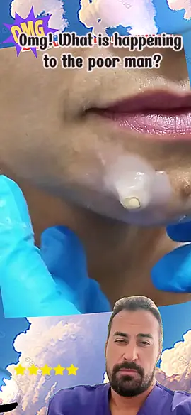 #squeezepip #pimples #blackheads #satisfyingvideo #satisfying #fyp 