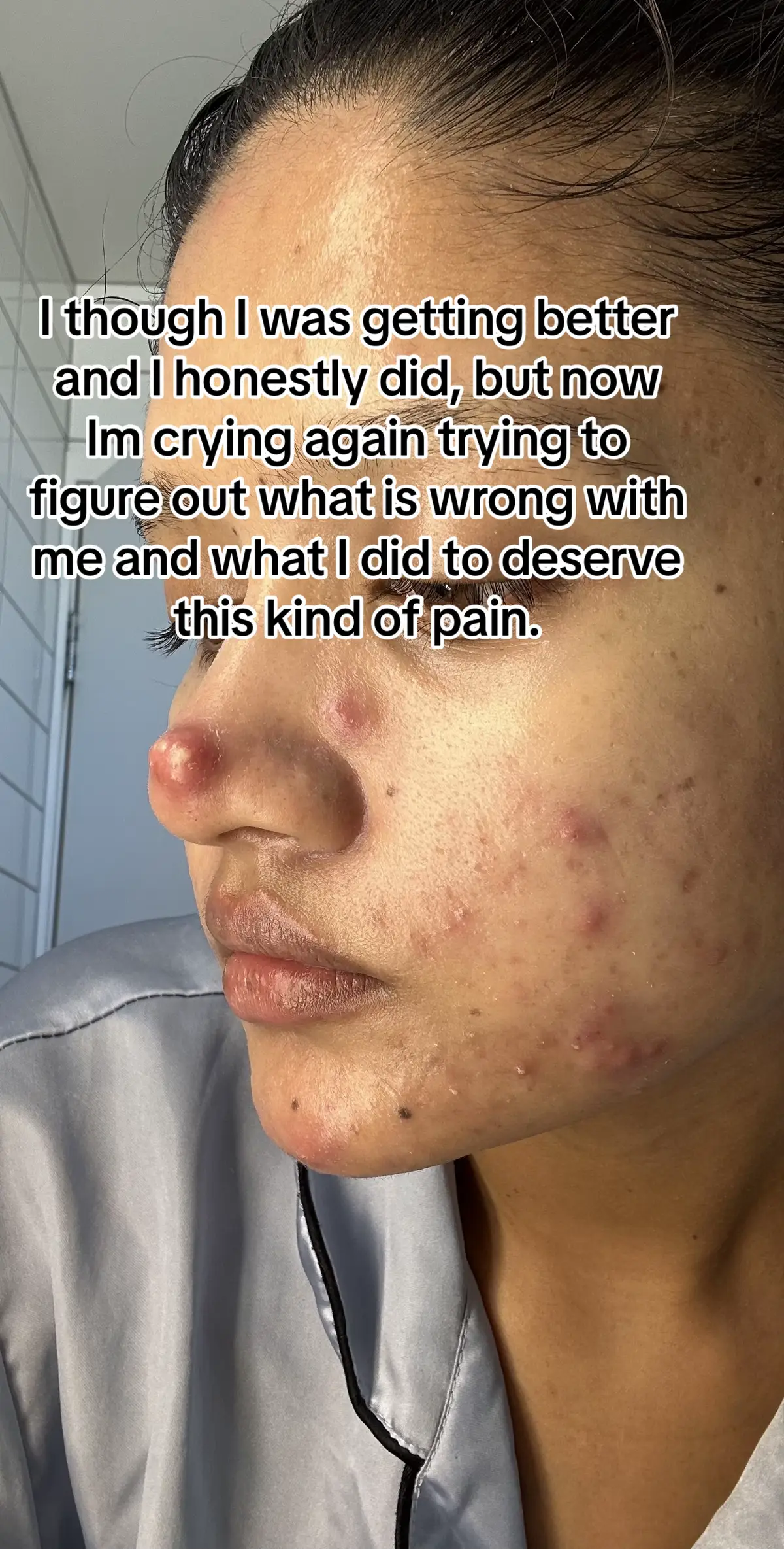 Cyst nightmare in full swing 😱. Is this normal? #acne #acnetreatment #cyst #acneskin #cysticacne #cysticfibrosis #isotretinoin #accutane #purge #acneproneskin #acnepositivity #acnefighter #acnejourney #skincare 