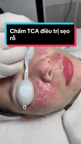 Chấm TCA điều trị sẹo rõ đáy nhọn! #trị_sẹo_rỗ #chômclinic