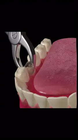 Here’s a 3D Animation demonstrating how teeth is extracted 😄 ☎️+1-(868)-474-6773 📌813 Southern Main Road, California ✅linktr.ee/islanddentaltt ✅For more dental & hygiene tips be sure to follow us on all platforms @islanddentaltt #fyp #foryoupage #dental #invisalign #trinitiktok #invisalignsmile #invisalignjourney #dentistry #dentist