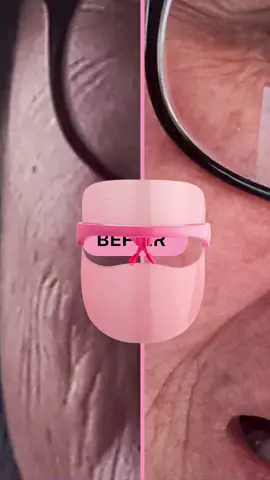 We LOVE seeing Before & After results by one of our fans using our Wrinklit LED Mask!! L ✨🥰🧖🏻‍♀️ #skingym #ledmask #ledlighttherapy #ledmasktherapy #beforeandafterskincare