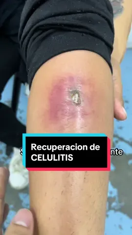 Recuperacion de Celulitis antes y despues  #celulitis #heridainfectada #doctorexplains #doctor #medicine #consultamedica #pepe_pepp #salud #parati #fypシ  @Pepe_pepp   <— parte 1