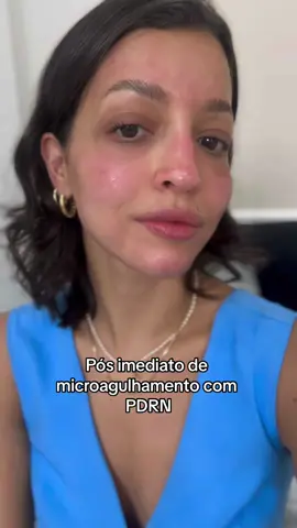 Pele glow, mais uniforme e com menos relevo vem ai 🤞🏻#limpezadepele #microagulhamento #microneedling #pdrn #estetica 