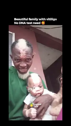 Beautiful family with vitiligo . . . . #vitiligo #africa #tiktok #Love #fyp #famouzdaily #viral #Nigeria 