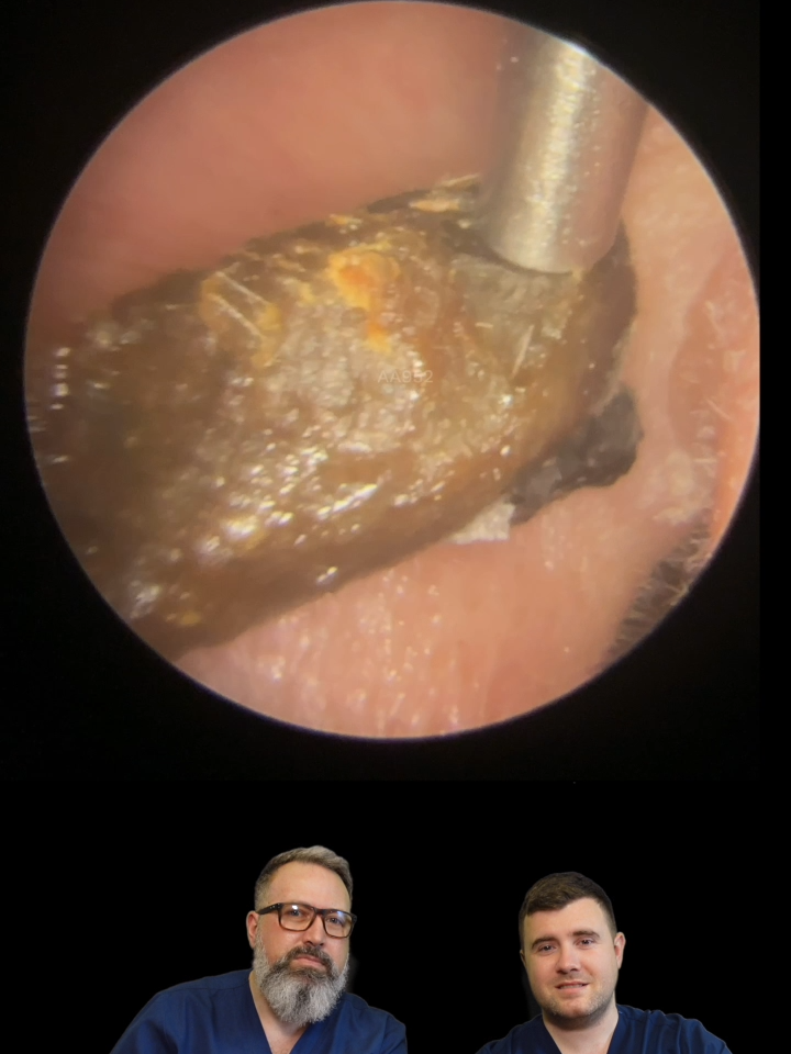 SUPER DIFFICULT DRY, STUBBORN EAR WAX REMOVAL - EP952.1 #audiologyassociates #earwax #earwaxremoval #earcleaning Thank you for watching our ear wax removal video today. The ear wax extraction featured in todays video was carried out using endoscopic microsuction. This procedure uses a small camera called an endoscope to visualise inside the ear canal whilst a small suction tube is inserted to gently remove ear wax.  All the ear wax cleaning videos you see on our channel are carried out by our ear wax specialists Mr Rhys Barber and Mr Taylor Green. Want to book an appointment? Check out our link tree: https://tr.ee/T7sSZnpw9z Affiliate Link to Olive Oil: https://geni.us/uIvcrP Affiliate Link to Sodium Bicarbonate: https://geni.us/k7UHke We post new ear cleaning videos Monday - Friday at 9PM GMT so if you find ear wax removal satisfying please consider subscribing to our channel. Ear wax plays a vital role in ear health. It helps to prevent ear infection and helps with ear cleaning by picking up any dirt or debris that accumulates in the ear canal. Normally this ear wax would fall out of the ear taking any dirt or debris with it.  How to remove ear wax?  Many people use q-tips/cotton buds for ear wax removal at home this is one of the worst things you can put into the ear as this can lead to an increased ear wax buildup or in extreme cases impacted ear wax. The best way to remove ear wax is to let your ears clean themselves and not to put anything smaller than your elbow in your ears! How do I know if I have an earwax blockage? If you experience a change in your hearing, discomfort in the ear or jaw or a feeling of fullness in the ear canal you may have an ear wax blockage. Our advice is to speak to your Doctor or local Audiologist who can take a look in your ears and assess whether ear cleaning is needed. To arrange an ear wax removal appointment please visit our website:  https://www.audiologyassociates.co.uk Follow us on: Facebook: https://en-gb.facebook.com/audiologyassociates1/ Instagram: https://bit.ly/2yDzQeM Twitter: https://twitter.com/AudiologyA