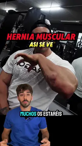 ❗️👇🏽IMPORTANTE👇🏽❗️ 🤔 Es poco común sufrir una hernia muscular, sin embargo se pueden encontrar en varios puntos de tu cuerpo. 👉🏼Las hernias musculares no suelen dar molestias pero pueden causar rechazo en las personas. 🚨 En todo caso, el tratamiento es el quirúrgico. ❕SIGUEME PARA ALIVIAR TU DOLOR Y RECUPERARTE GRATIS❕ #fisioterapia #fisio #dolor #dolorcronico #dolorcervical #dolordeespalda #rehabilitacion #anatomia #anatomiahumana #ejercicio #Fitness #manguitorotador #hombro #ciática #lesión #terapiamanual #manipulacionvertebral #menisco #cervicales #dolordebrazo #cervicobraquialgia 