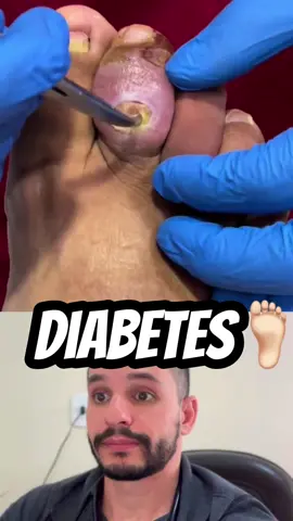 O pé diabético é uma série de alterações que podem ocorrer nos pés de pessoas com diabetes não controlado. Infecções ou problemas na circulação dos membros inferiores estão entre as complicações mais comuns, provocando o surgimento de feridas que não cicatrizam e infecções nos pés. Se não for tratado, o pé diabético pode levar à amputação. Sintomas: – formigamento; perda da sensibilidade local; dores; queimação nos pés e nas pernas; sensação de agulhadas; dormência; além de fraqueza nas pernas. Tais sintomas podem piorar à noite, ao deitar. Normalmente a pessoa só se dá conta quando está num estágio avançado e quase sempre com uma ferida ou uma infecção, o que torna o tratamento mais difícil devido aos problemas de circulação. Tratamento: A abordagem deve ser especializada e deve contemplar um modelo de atenção integral (educação, qualificação do risco, investigação adequada, tratamento apropriado das feridas, cirurgia especializada, aparelhamento correto e reabilitação global), objetivando a prevenção e a restauração funcional da extremidade afetada.