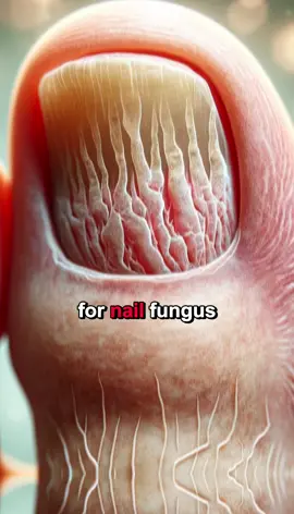 Nail fungus is a common problem, but it doesn't have to be a permanent one! 🙌 EMUAIDMAX®️ has helped countless people achieve clear, healthy-looking nails. 👣 Get it now on the TikTok shop, but hurry – this offer won't last forever! #emuaid #nailfungus #toenailfungus #nailfungusremedies #fungalnail 