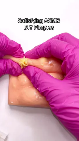 Satisfying ASMR DIY pimples!! #asmr #asmrsounds #fyp #satisfying #relax #acne #skincare 
