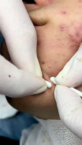 #laynhanmuntambong #munskin #laynhanmunchuanykhoa #laymunquan9 #laymunthuduc #laynhanmun #laymun #trimun 