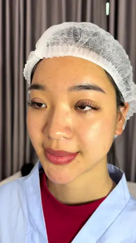 Mọi người còn nhớ ca mí sửa ngày khai Xuân ở Bắc ninh này của em chang k ạ Đôi mắt của em cắt bị to quá, đính cơ quá sâu khiến dồi mắt Lờ đờ buồn ngủ, nhìn thẳng thì chông hơi lé Sau 4 tháng mí sửa vào phom thì nay e đã có một đôi mắt đẹp , có đúng là dối mắt là cửa sổ tâm hồn k cả nhà ơi🫶🫶🫶🫶