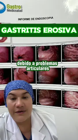Gastritis erosiva ocasionada por el consumo de analgésicos  No debes automedicarte porque podria ser perjudicial para tu salud 🙅‍♀️ Si tienes problemas gastrointestinales agenda una cita con nosotros ✅ #gastritiscronica #gastritis #gastritisremedionatural #gastritiserosiva #gastritischeck #gastromedic 