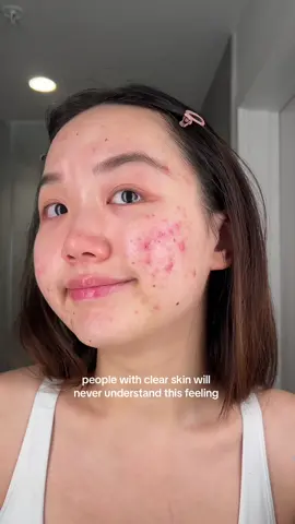 I’m sharing this not for sympathy, but because I know I’m not alone in this struggle. We all have our battles, but acne touches on something deeply personal and can really affect how we see ourselves and interact with others. I’m trying to remind myself that my skin doesn't define my worth, and that healing is a journey, not just physically but emotionally too. If you’re also having a tough day, remember, it's okay to not be okay. Our imperfections make us human, and sharing them can make us stronger. Let’s support each other. 🤗 💪 #fyp #viral #relateable #acneskin #redness #HealingJourney #acnejourney 