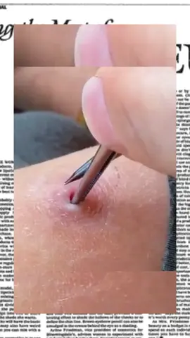 #squeeze #squeezeyuk #acne #pimple #pimplepop #blackhead #satisfying #foryoupage