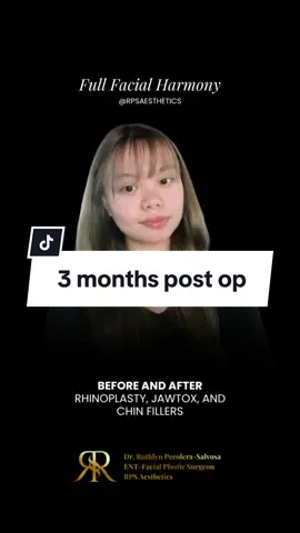 Small Nose Rhinoplasty Update👃🏻 3 months post op. Case: “Pango” or Oriental Nose Goretex, Mesh, and Ear Cartilage Rhinoplasty. Ruby Shai’s before and after, just 10 weeks after her surgery. Visit us! 👇🏻 👩🏻‍⚕️ RPS Aesthetics ☎️ 0930 896 9228/ (02) 7001 3150 📍 J & S Building, 104 Kalayaan Avenue, Diliman, Quezon City Other clinic locations: 📍 Cinco Marias Aesthetic Clinic and Wellness Spa, Batangas 📍 Drents Multispecialty and Aesthetic Clinic, Pampanga #rhinoplastyphilippines #rpsaesthetics #rhinoplastyfairy #drruthlyn #drruthlynpecolerasalvosa #rhinoplastytips #RPSRubies #RPSRuby #RPSBaby Rhinoplasty Rhinoplasty Before and After Rhinoplasty Philippines Rhinoplasty PH Rhinoplasty Journey Rhinoplasty Transformation Nose job Nose job check Nose job PH Rhino healing process Rhino journey Rhino before and after Rhino in the Philippines Rhinoplasty Philippines Rhinoplasty Manila Rhinoplasty Journey Rhinoplasty Before and After Rhinoplasty For Small Nose Rhinoplasty Journey Videos Sail excision alar Nose Rhinoplasty Results Tiktok Rhinoplasty Surgery Reviews Pampanga Rhinoplasty Pampanga Surgeon Pango Oriental Nose