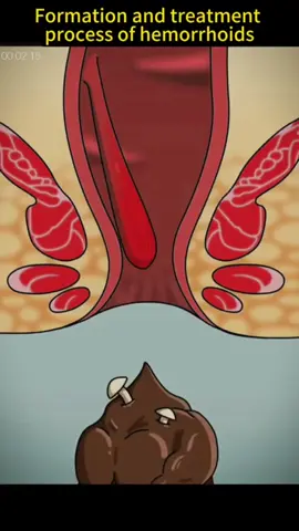 Hemorroides #medicinatiktok #videoviral #parati 