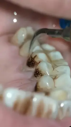 máy lấy cao răng tại nhà FIKO T6 PRO  #tienichnuocvahoa #caorang #maylaycaorangtainha #maylaycaorang #laycaorang #vesinhrangmieng 