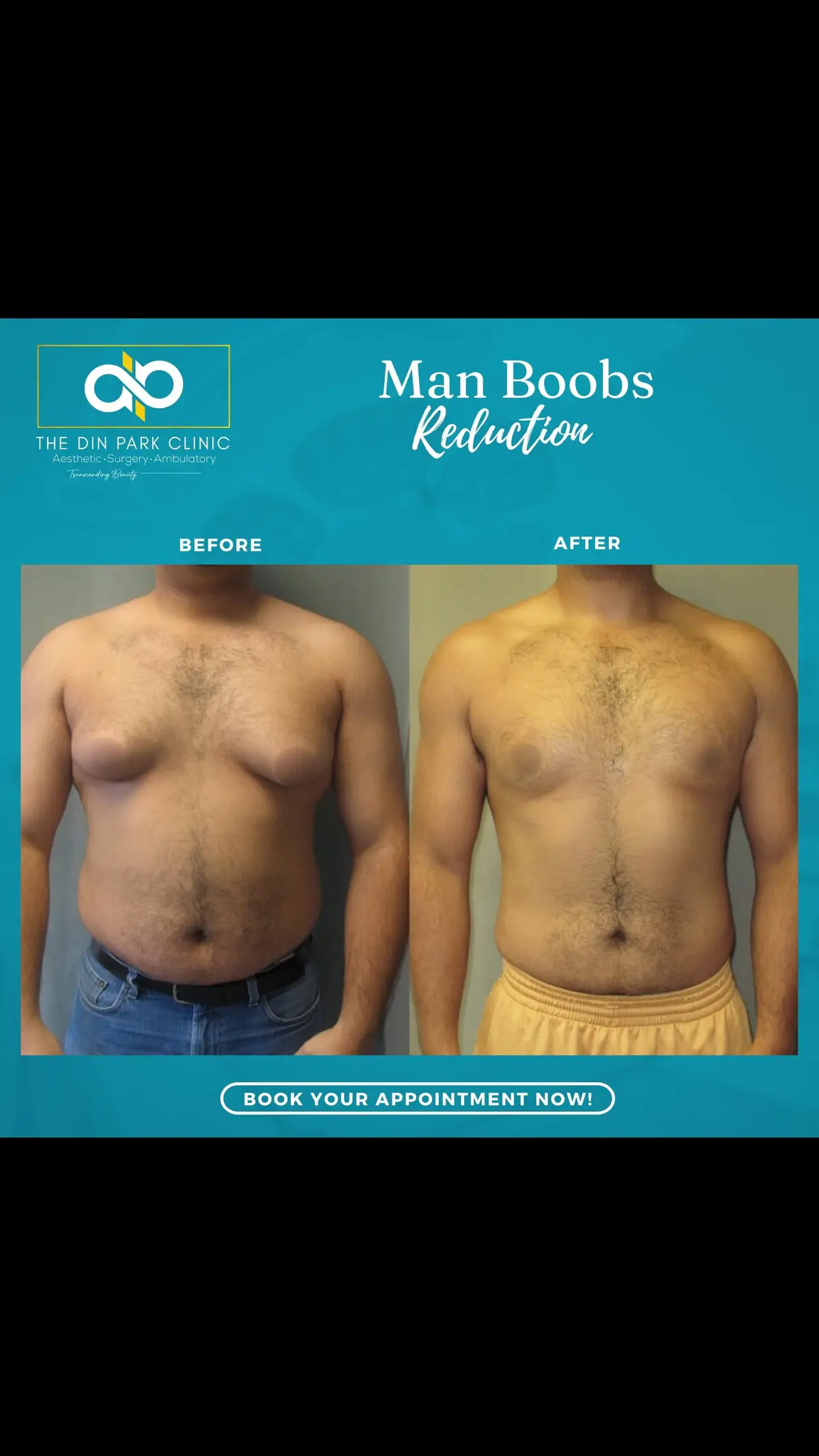What is Gynecomastia or Man Boobs?  -is the enlargement of male breast tissue, which can be addressed through a surgical procedure when it does not respond to other forms of treatment or if it causes significant discomfort or distress. The procedure typically involves the removal of excess breast tissue and fat to achieve a flatter, more masculine chest contour. Here are the details of the gynecomastia procedure: **1. Consultation:** - The first step is a consultation with our dinpark surgeons to discuss your goals and medical history. - The surgeon will assess the severity of gynecomastia and decide on the most appropriate approach. **2. Procedure Overview:** - **Anesthesia:** The surgery can be performed under general anesthesia or local anesthesia with sedation, depending on the case. - **Liposuction:** If the gynecomastia involves mostly fatty tissue, liposuction may be used to remove the excess fat. Small incisions are made, and a thin cannula is used to suction out the fat. - **Tissue Excision:** For more significant glandular tissue or skin excess, tissue excision may be necessary. Incisions are made around the areola or under the armpit, depending on the surgeon's approach, and the excess tissue is removed. - **Combination Approach:** In some cases, both liposuction and tissue excision may be used to achieve the best results. **3. Recovery:** - **Post-Operative Care:** After the procedure, you will need to wear a compression garment to reduce swelling and support the chest area during healing. - **Follow-Up Appointments:** Your surgeon will schedule follow-up appointments to monitor your healing and ensure proper recovery. - **Healing Time:** Initial recovery can take a few days to a week, with full healing taking several weeks. It's important to avoid strenuous activities during this time. **4. Results:** - The goal is to achieve a flatter, more masculine chest contour. - Results can often be seen immediately after the procedure, though swelling may take a few weeks to fully subside.