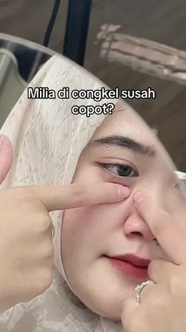 milia dicongkel?! pakai serum ini aja besti, serum khusus milia hitungan hari milia copot #serummilia #milia #serummiliadibawahmata #miliacopot #promoguncang55 #leikaskincare #miliaambrol 