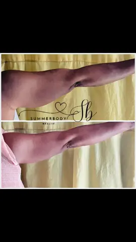 Graisse des bras?client satisfait 💯💯#graisse #armfat #viral #foryou #pourtoi #fyp #videoviral #trending #summerbody 
