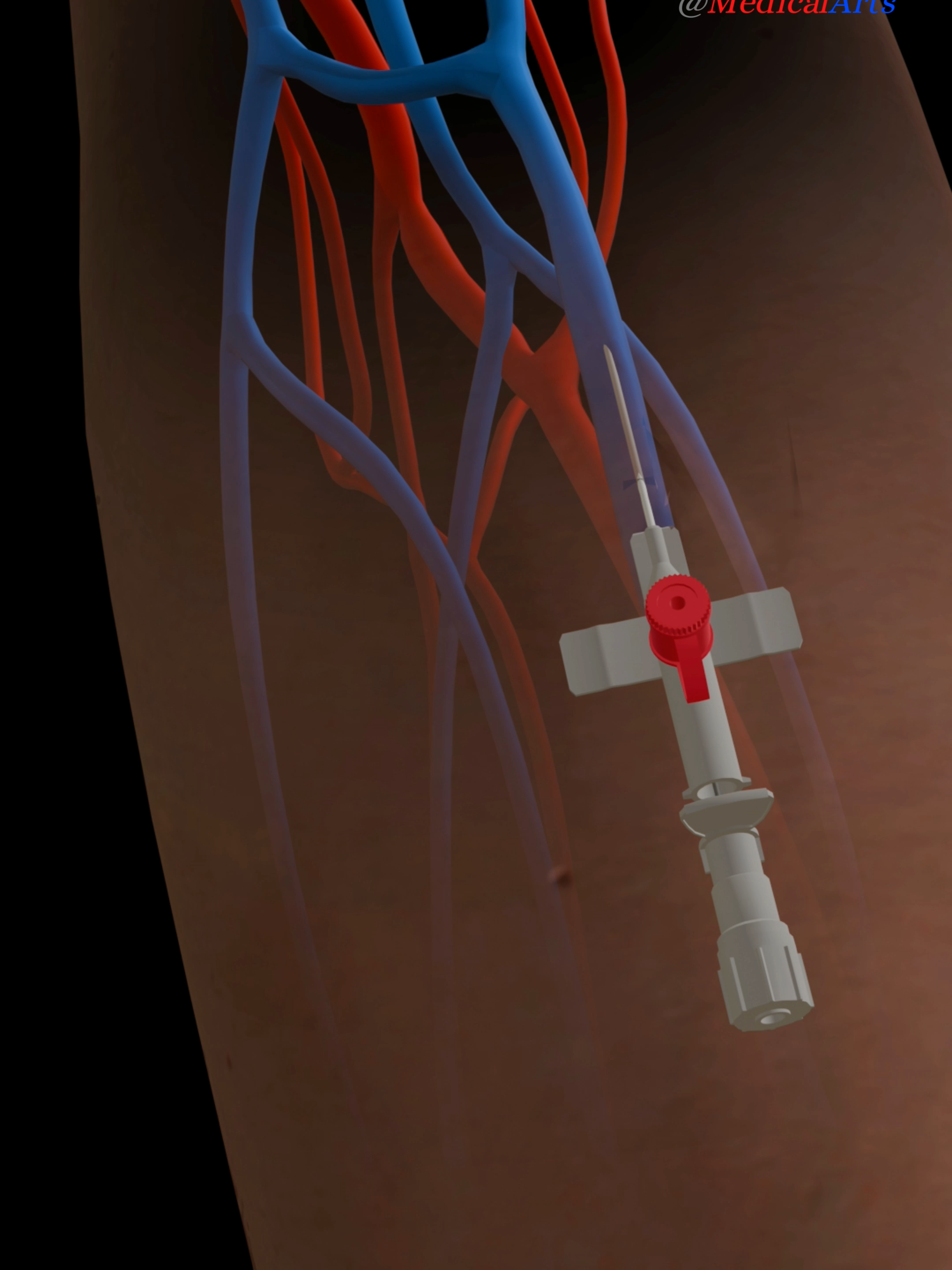 Iv insertion 3D animation #ivtherapydrip #ivhydration #ivinsertion #ivtherapy