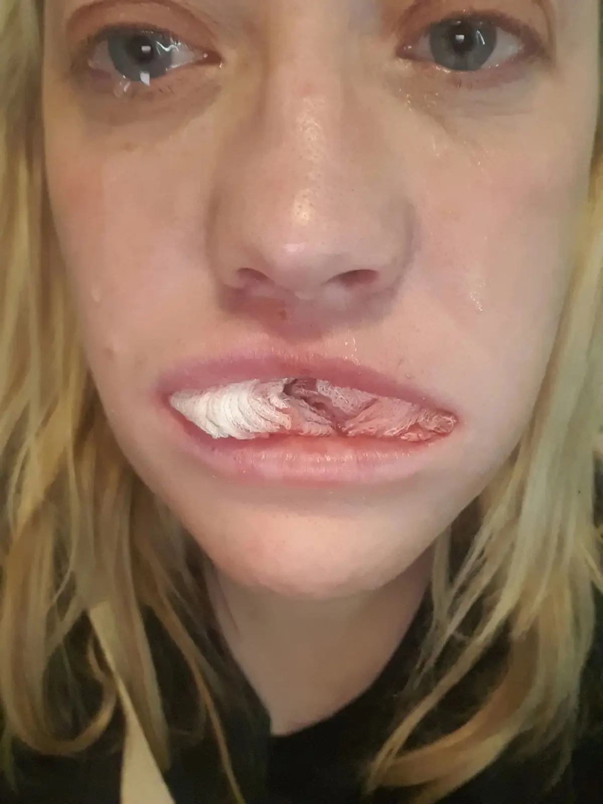 The pain was horrendous as you can see the screws are in i felt like the man from jaws  Help #scared  #turkeyteeth  #turkey  #smile  #pain  #realstory  #followmyjourney❤️  #journey  #dental #dentalimplants 