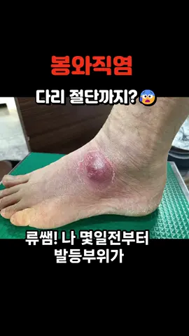 봉와직염 우습게 보지마세요! #봉와직염#건강 #지식 #스토리 #이슈 #류창현 