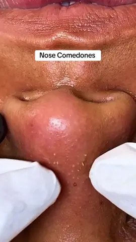 Nose comedones Oil Skin removal #pimplepoppersatisfying #pimple #acne #pimplepop 
