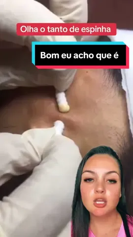 Olhando bem o video não parece espinha #cravos #limpezasatisfatoria #reagindo 