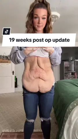 Tiktok, this is for educational purposes ❤️ and i’m wearing swimsuit bottoms. #tummytuck #tummytuckjourney #fdltummytuck #looseskin #looseskinremoval #weightloss #beforeandafterweightloss 