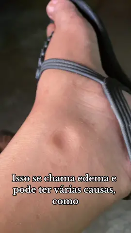 Edema, também conhecido como retenção de líquidos, é o inchaço causado pelo excesso de líquidos nos tecidos do corpo.🫀 #edema #saude #enfermagem 