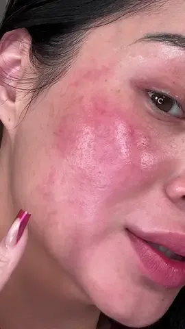 This is the reality of my skin. I know you’re used to seeing me have flawless smooth skin but everytime my rosacea breaks out from stress this is what my skin actually looks like up close and I literally feel soooo fugly lol  I’m trying out @Cetaphil US today for the first time because 25 dermatologists I interviewed told me to.
