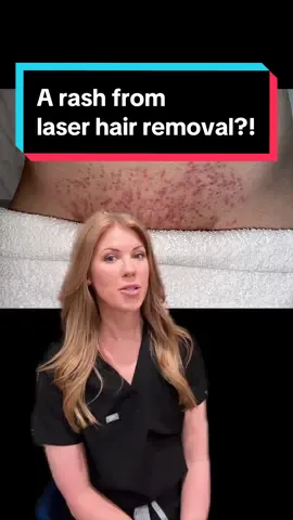 If you see this after your laser hair removal appointment; don't freak out! Instead, it's a sign that the treatment is working. #laserhairremoval #laserhairremovaltreatment #hairremoval #skin #skincare #skincaretips  