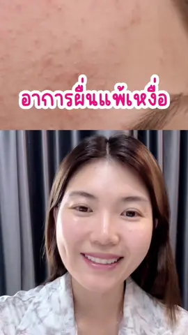 เเพ้เหงื่อ จะมีอาการอย่างไรนะ มาดูกัน #เเพ้เหงื่อ #เเพ้ #คัน #เภสัชเกรซ 