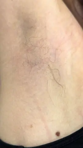 Laser hair removal #viral #fyp #explore #اكسبلور #tiktoklongs #foryoupage #beauty 