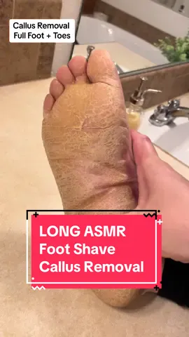 Happy weekend! #callusremoval #parmeseanpalms #feet #dermatologist #podiatrist #asmrtiktoks 