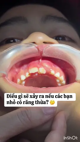 Điều gì có thể xảy ra nếu các bạn nhỏ có răng thừa vùng răng cửa hàm trên. 🤔🤔🤔
