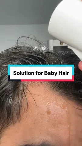 Tip: if you want to thicken baby hair, do like me! Minoxidil + rosemary water. Look at the result on me ! #fyp #pourtoi #minoxidil #treatment #alopecia #calvitie #babyhair #hack
