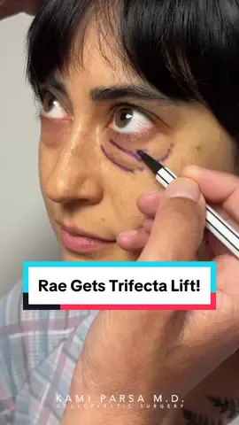 Inside the OR with Dr. Parsa! Dr. Parsa shares his approach to performing his signature Trifecta Lift procedure. #eyes #eyebags #darkcircles #undereyebags #kamiparsa #eyemakeup 
