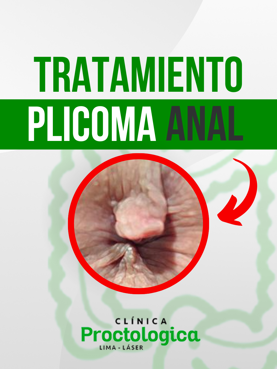 🎥🍃 ¡Atención! La Dra. Milagros de la Clínica Proctológica de Lima te cuenta TODO sobre el plicoma anal. ¡No te pierdas sus consejos y descubre si hay tratamiento! 💚  #plicomaAnal #SaludProctológica #PERU #LIMA #polipo #SaludEnLima #ClinicaVerdeBlanco #DraMilagros #Proctología #InformaciónSalud #dramilagrosquinto #clinicaproctologica #clinicaproctologicalima #embarazo