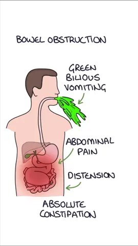 An overview of bowel obstruction #medicine #medicalstudent #surgery #generalsurgery #medstudent 