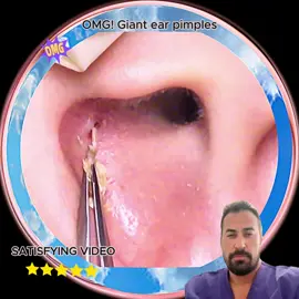 Huge blackheads on ear#squeezepip #pimples #blackheads #satisfyingvideo #satisfying #fyp 