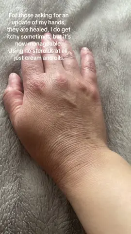 @💟😾💟  an update of my hands.  Doing well so far. #dairyfree #eczema #eczemaawareness #eczematok #eczemaflareup #eczemaupdate #eczemaupdate #eczemalife 