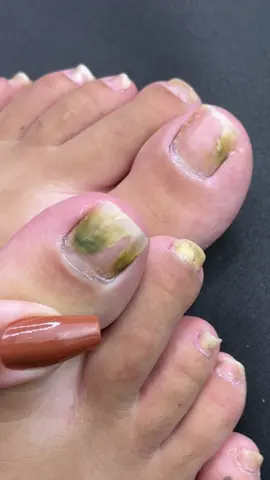Unhas dos pés com fungos 😭 vou tomar um remédio semanal, tomara que melhore 🙏🏻 #unhasdospes #podologia #podologa #unhaencravada #unhas #unhainflamada #fypシ゚viral 