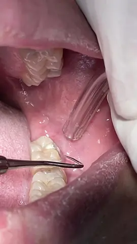 Deep tooth caries #dentist #teeth #dental #dentista #usadentist 