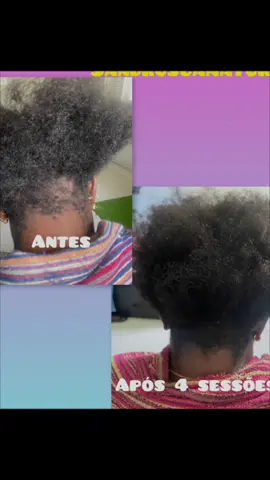 Após 4 sessões de terapia, notamos o crescimento na área afectada com a queda capilar.  #alopecia #quedadecabelo #quebradecabelo #alopeciaandrogenetica 